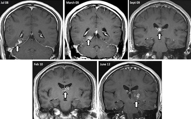 Hombre vive con un gusano en el cerebro Hombre vive con un gusano en el cerebro