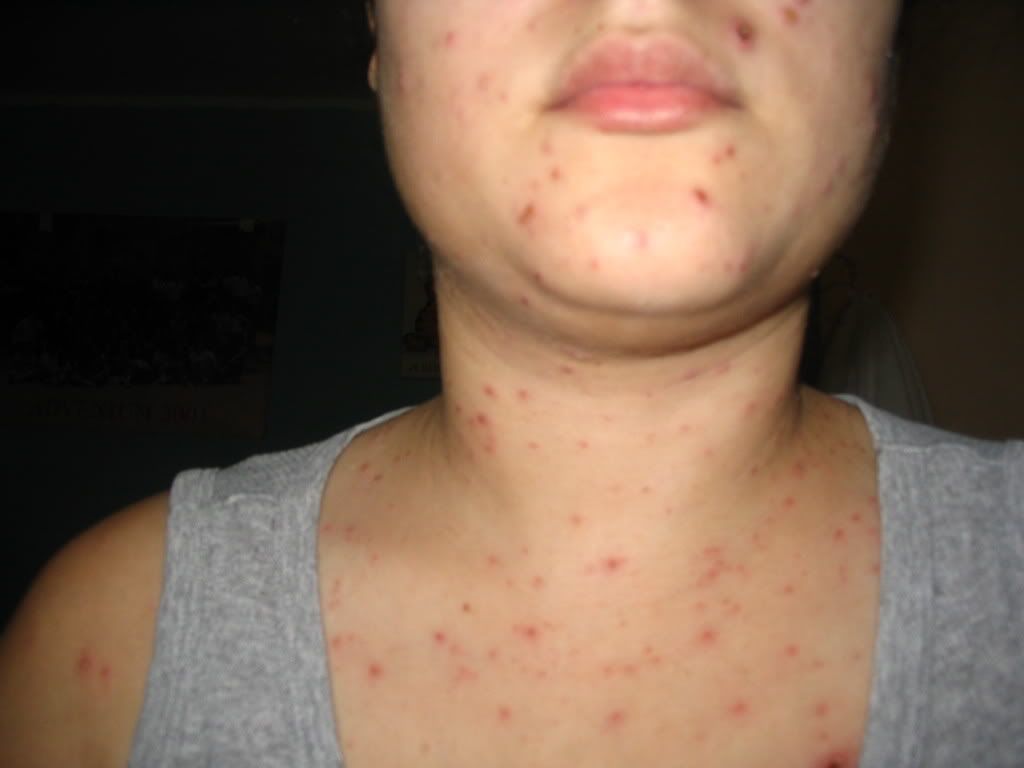 Crece el número de contagiados de sarampión en EE.UU.