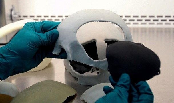 Fabrican implantes craneales con tecnología 3D