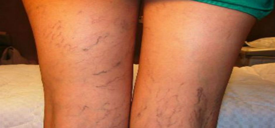 ¿Cómo evitar la aparición de varices? ¿Cómo evitar la aparición de varices?