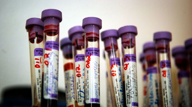 Científicos españoles detectan Alzheimer con un análisis de sangre