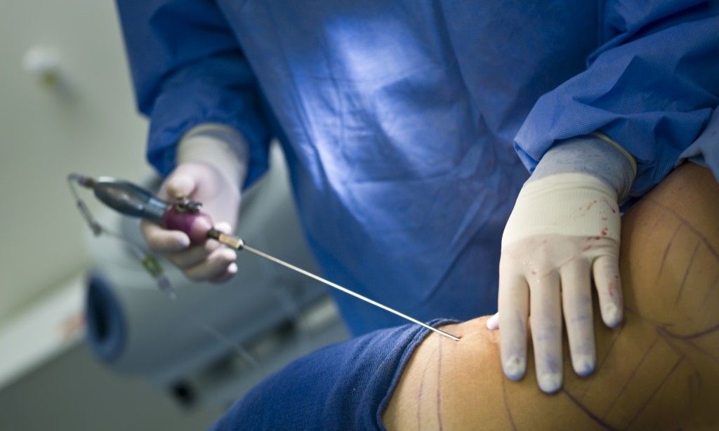 Mujer muere después de realizarse liposucción en Tabasco - Liposuccion-photo-1024x614