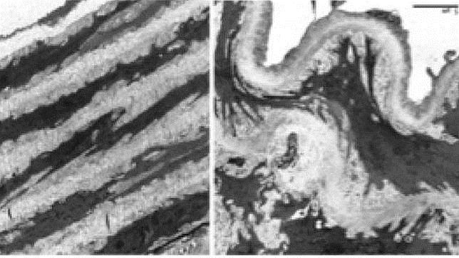 Investigadores encuentran un posible tratamiento del aneurisma