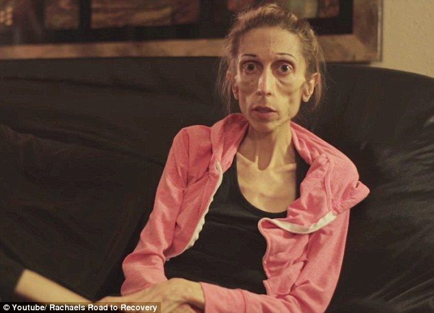Video: Mujer con anorexia pide ayuda para recuperarse Video: Mujer con anorexia pide ayuda para recuperarse