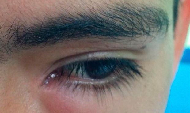 Video: extraen larva del ojo de un adolescente Video: extraen larva del ojo de un adolescente