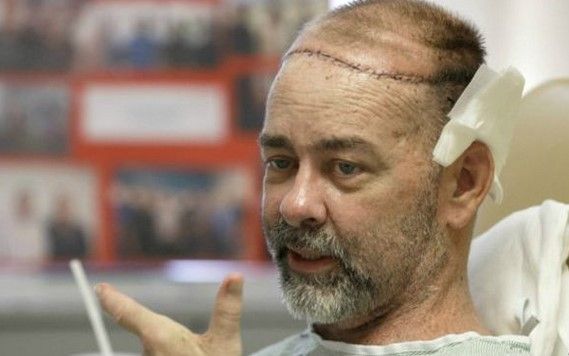 Primer trasplante de cráneo y cuero cabelludo en el mundo