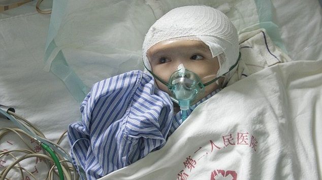 Trasplantan cráneo impreso en 3D a niña china con hidrocefalia