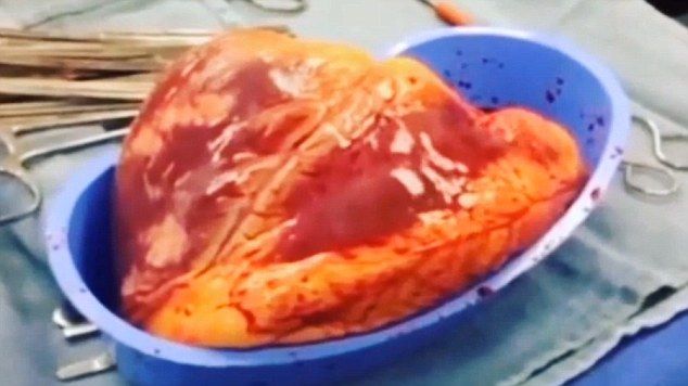 Video: corazón extirpado de cocainómano continúa latiendo por 25 minutos Video: corazón extirpado de cocainómano continúa latiendo por 25 minutos