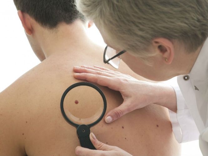 Cáncer de piel afecta más a hombres: SSA Cáncer de piel afecta más a hombres: SSA