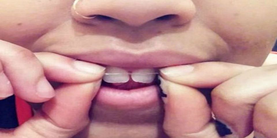 Video: peligrosa alternativa a los frenos dentales Video: peligrosa alternativa a los frenos dentales