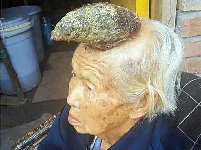 Video: mujer con cuerno desconcierta a los médicos