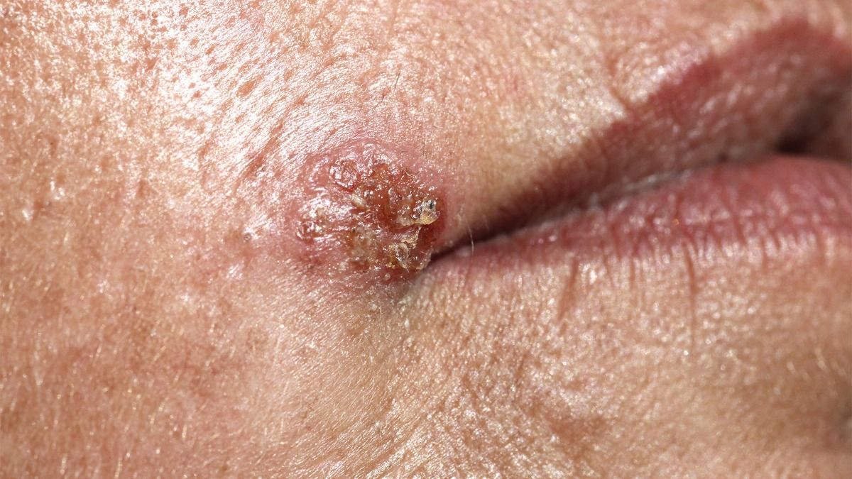 Más de la mitad de las personas en el mundo infectadas con herpes: OMS - HerpesColdSore