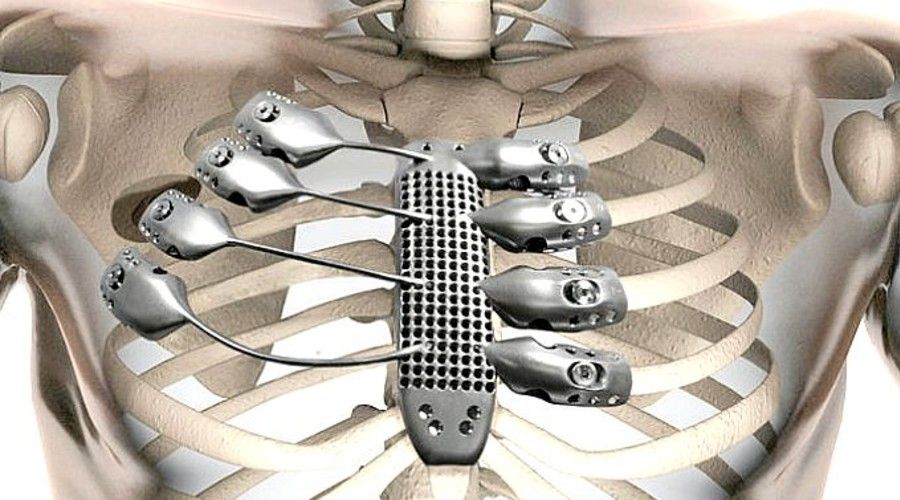 Crean esternón de titanio en impresora 3D