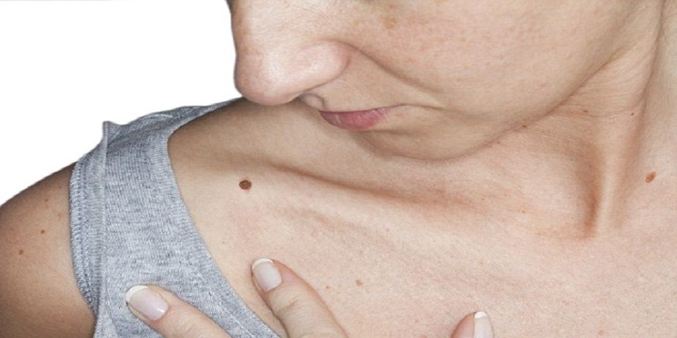 Desarrollan aplicación que permite examinar lunares malignos