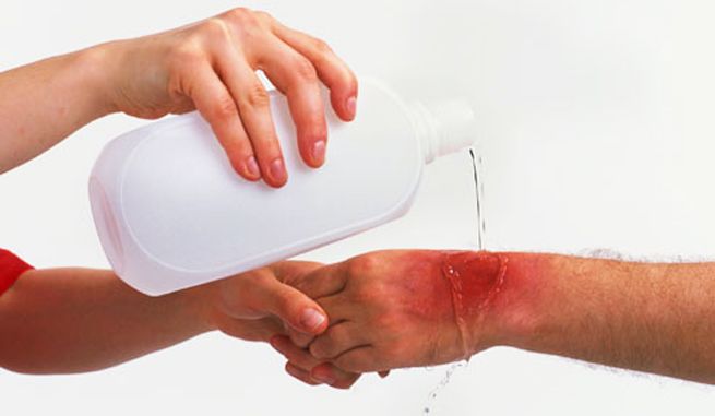 En época de invierno incrementan quemaduras en niños en 40 por ciento - Remedios-caseros-para-quemaduras