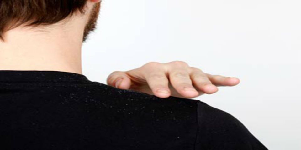 Cinco remedios caseros para combatir la caspa