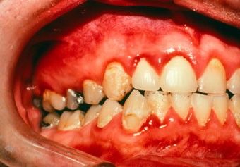 Los 10 puntos para mantener una buena higiene bucal - gingivitis