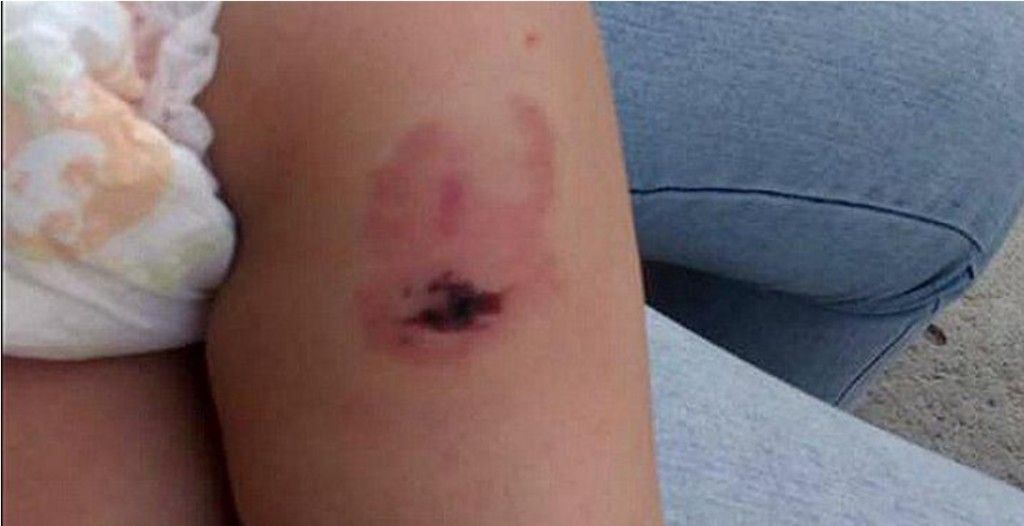 Fiscalía investiga a guardería donde bebé sufrió 16 mordeduras - mordedura-perro-1024x526