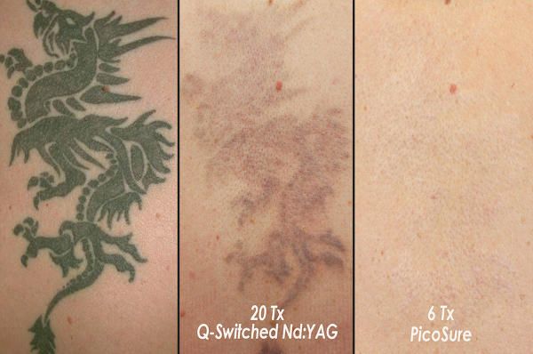 El láser que borra eficazmente los tatuajes - antes-despues-tatuaje-picosure