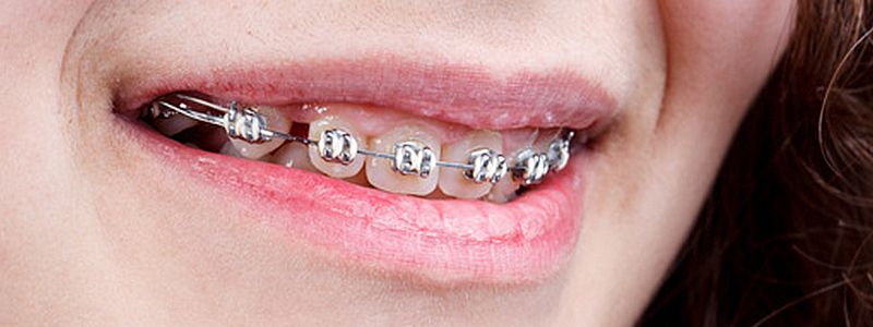 Científicios de la UNAM desarrollan nuevo adhesivo para brackets