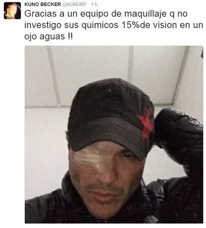 Pierde Kuno Becker visibilidad en un ojo - @Kunoojo