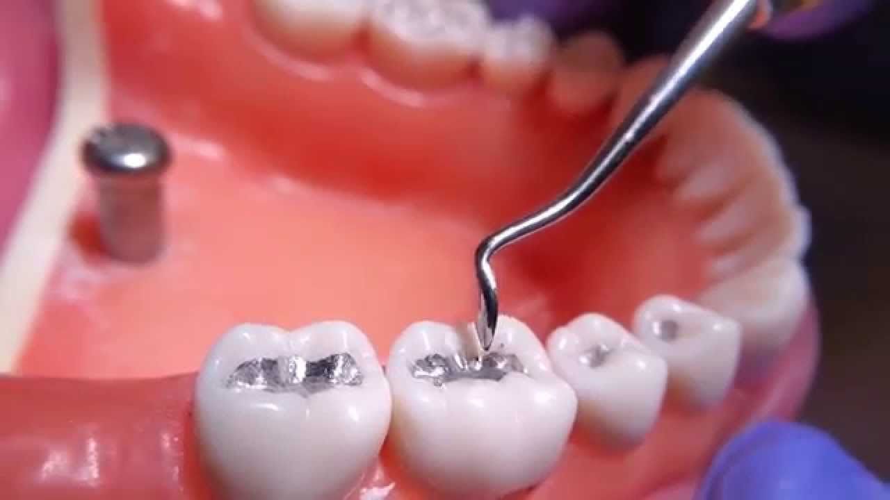 ¿Por qué se ponen amarillos los dientes? - Amalgamas-de-plata