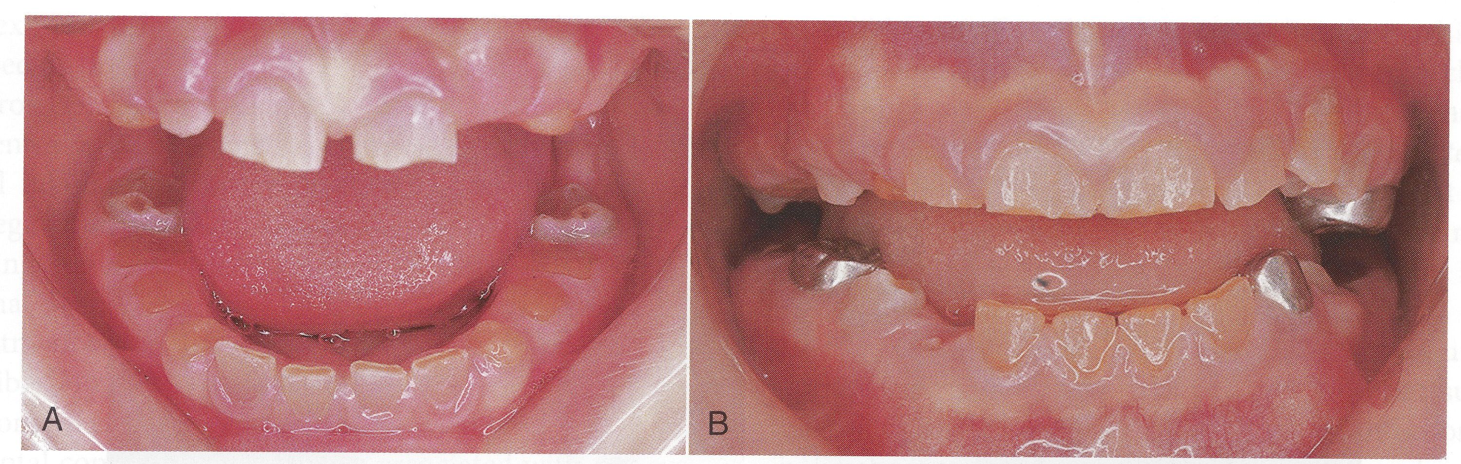 ¿Por qué se ponen amarillos los dientes? - Dentinogénesis