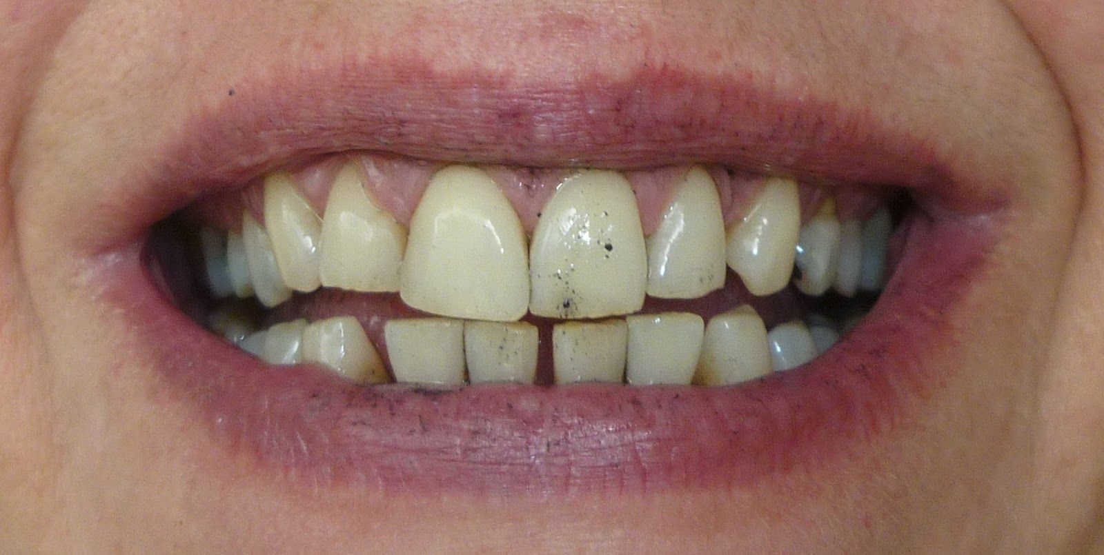 ¿Por qué se ponen amarillos los dientes? - Dientes-3