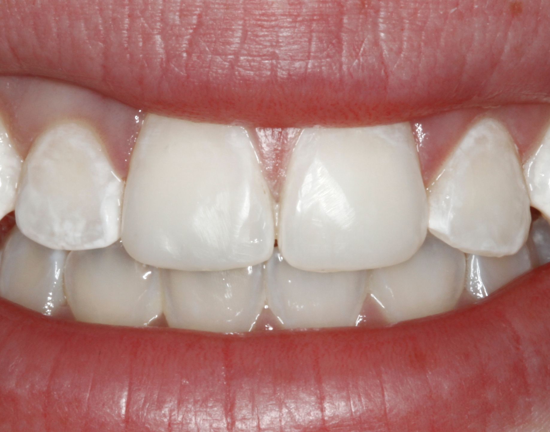 ¿Por qué se ponen amarillos los dientes? - Dientes-4