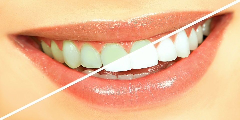 ¿Por qué se ponen amarillos los dientes? ¿Por qué se ponen amarillos los dientes?