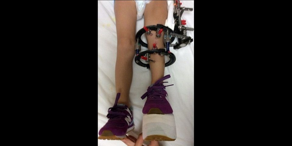 Madre rompió 300 veces la pierna de su hija para evitar amputación