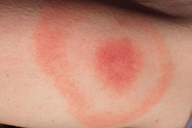 ¿Qué es la enfermedad de Lyme? - Malattia-di-Lyme-attenzione-alle-punture-delle-zecche1