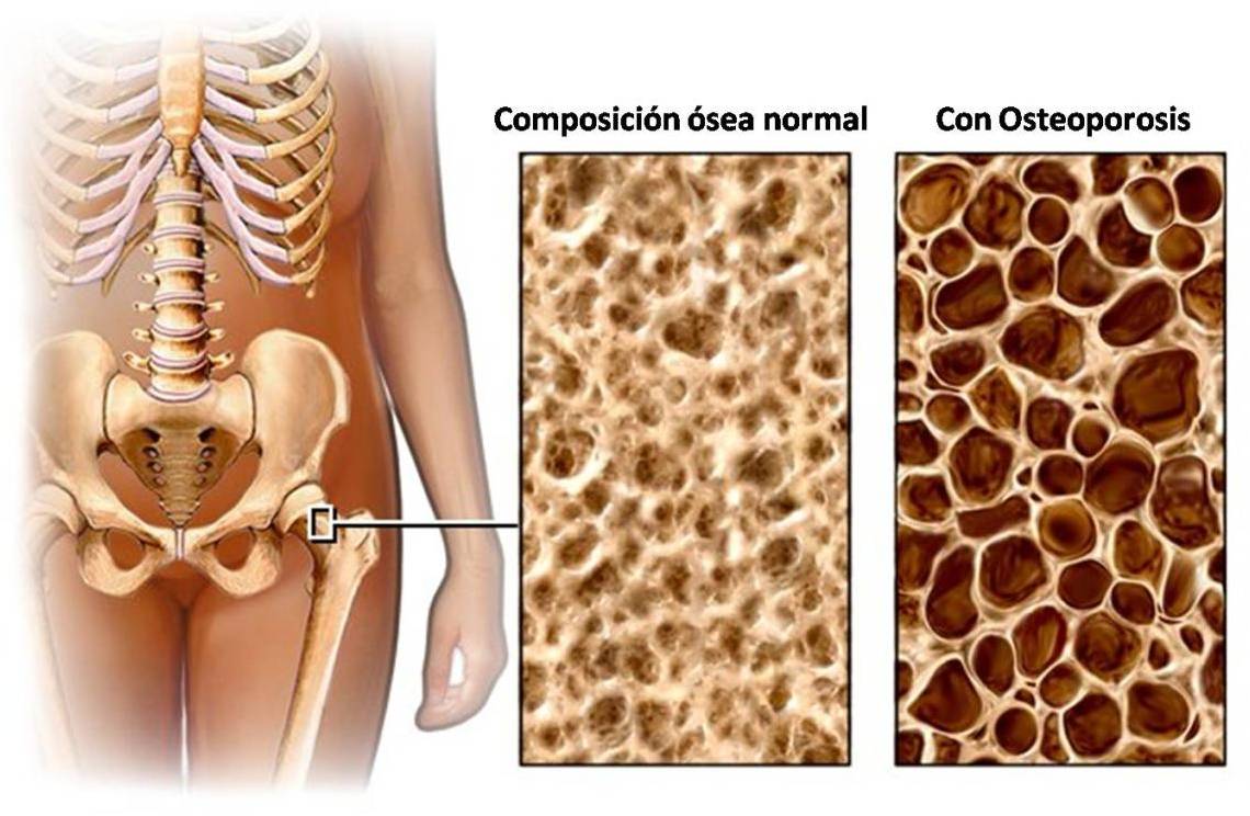 Aceite de oliva ayuda a prevenir el cáncer - Osteoporosis-Nutri-Pharma-