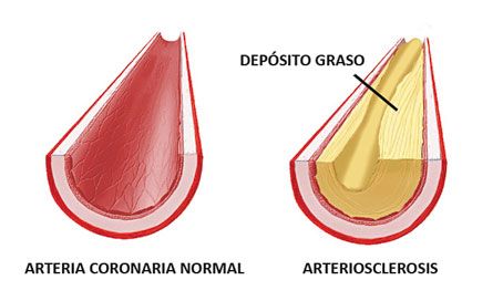 Personas entre 30 y 45 años, más susceptibles a padecer un infarto - cardiopatía-buceo-21