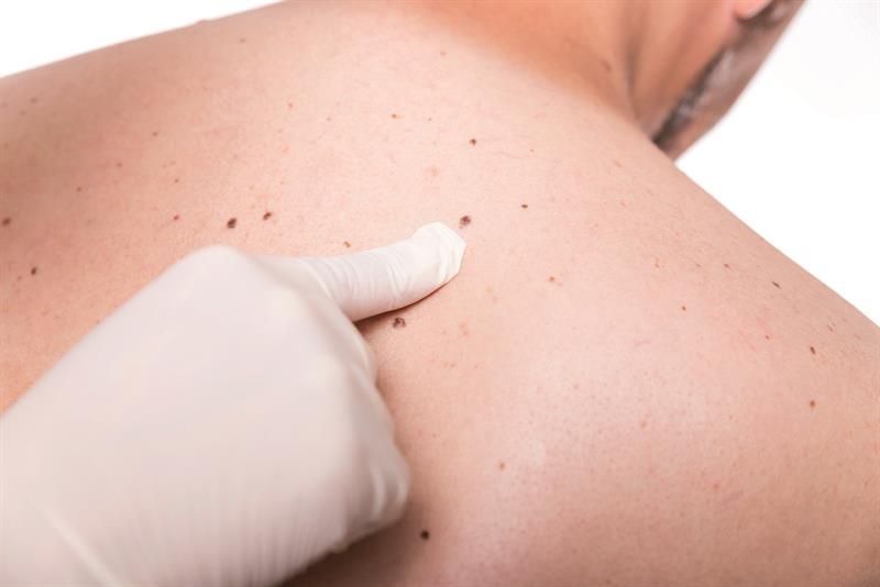 ¿Cómo distinguir un lunar de un melanoma? - Melanoma-Independent-Nurse