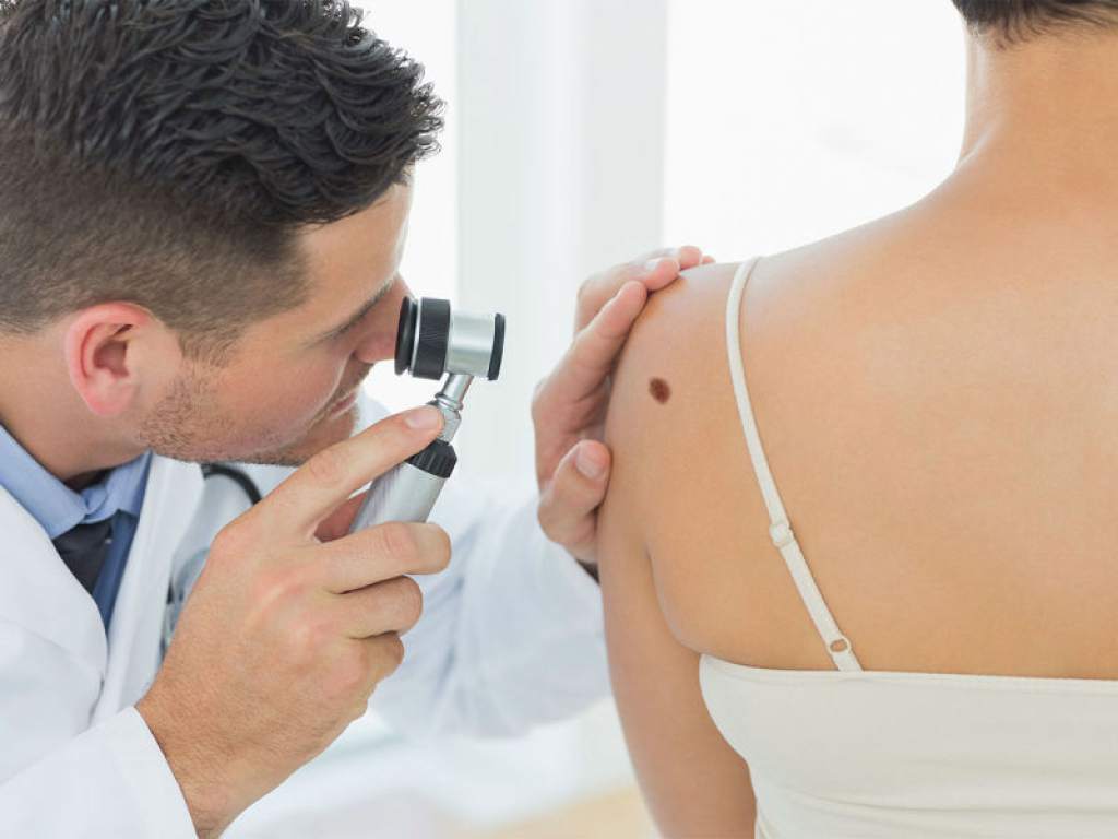 ¿Cómo distinguir un lunar de un melanoma?