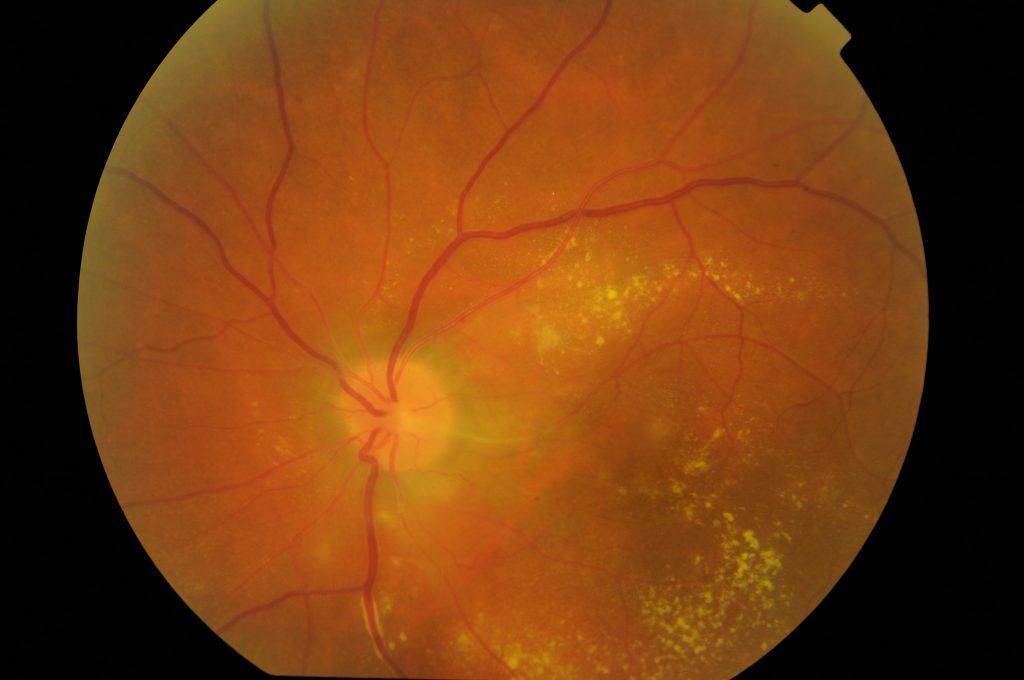 Realizarse un tatuaje podría ocasionar problemas en los ojos - Uveitis-1024x680