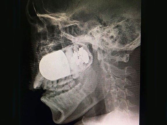 Extraen quirúrgicamente una granada activa del rostro de un soldado - granada2