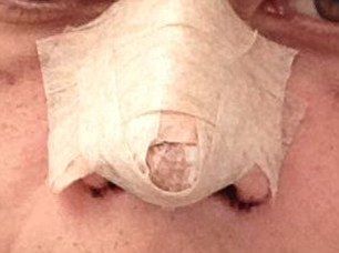 Supuesta cirujana plástica desfiguró a víctimas en Guanajuato - rinoplastia-1