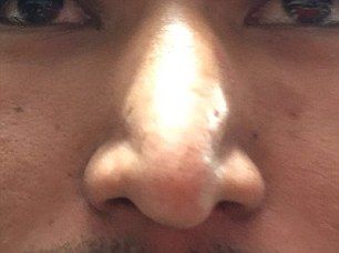 Supuesta cirujana plástica desfiguró a víctimas en Guanajuato - rinoplastia-2