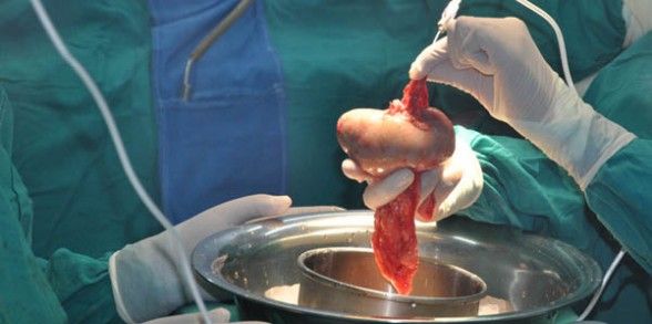 Trasplante de riñón exitoso en Tamaulipas