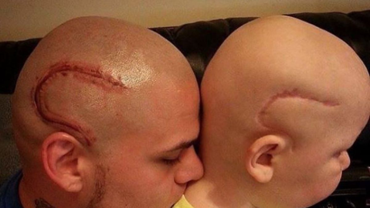 Hombre se tatúa la misma cicatriz que le dejó el cáncer a su hijo