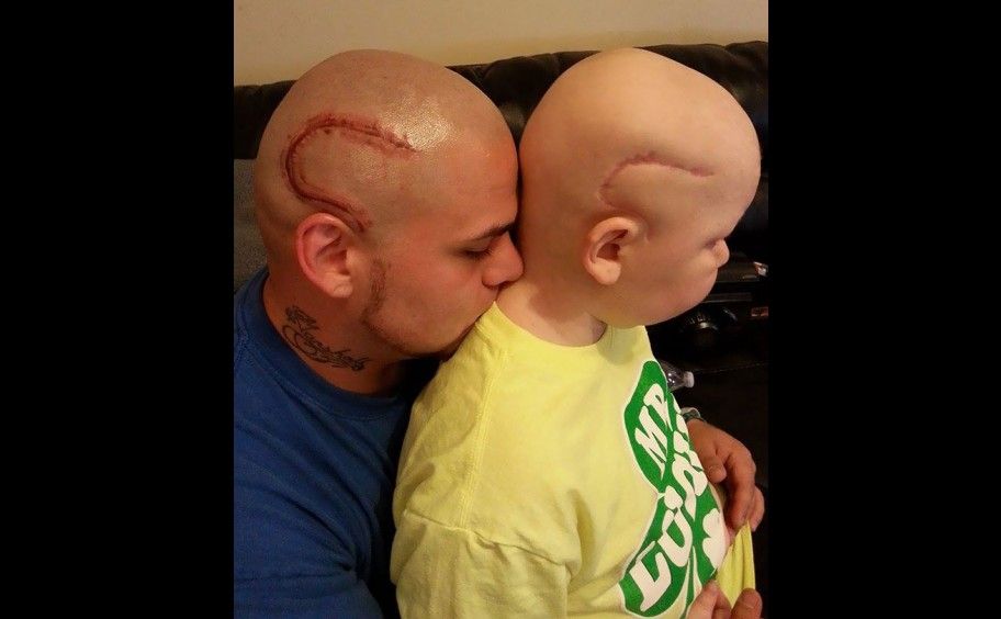 Hombre se tatúa la misma cicatriz que le dejó el cáncer a su hijo - scar-tattoo4