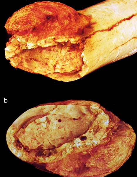 Hallan evidencia de cáncer en un antepasado del ser humano - cancer-huesos