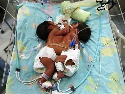 Separan exitosamente a siamesas en Perú