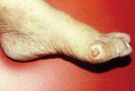 Los riesgos de usar tacones - ulceras