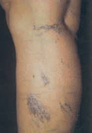 Los riesgos de usar tacones - varices