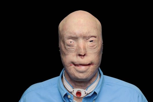 Video: bombero recibe rostro en el trasplante facial más largo de la historia - 13-face-transplant-2.nocrop.w529.h373