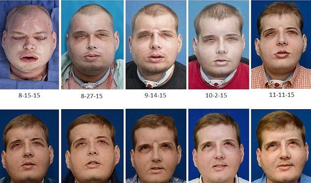 Video: bombero recibe rostro en el trasplante facial más largo de la historia