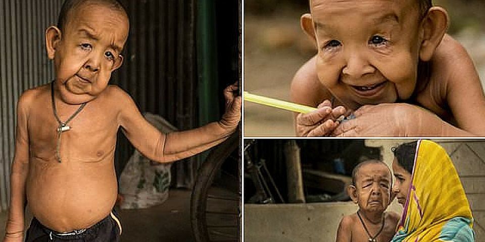 Enfermedad provoca que niño de cuatro años parezca un anciano